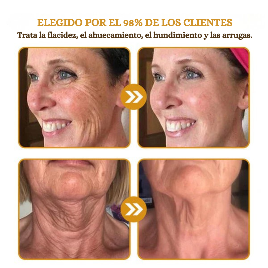 (✅Fabricado Desde Canadá👨⚕️) Crema para eliminar arrugas con veneno de abeja y botox Furzero™