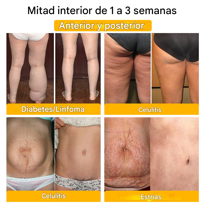 Oferta relámpago 2025🔥: Shorts moldeadores Anyidea® de fibra de titanio y turmalina de grado médico (¡Último día: 80 % de descuento! 🚨)