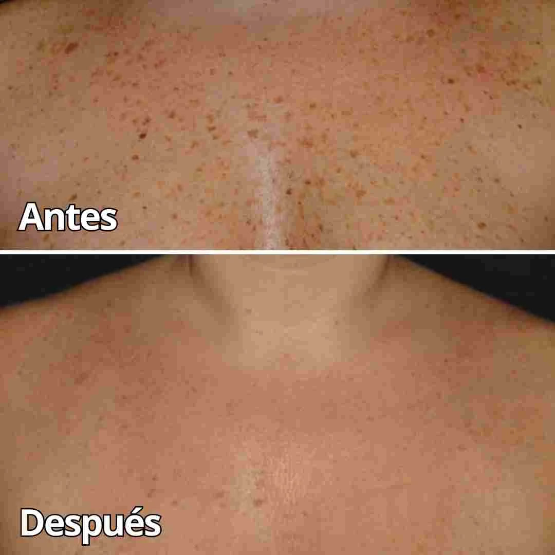 Tratamiento Crema Veneno De Abeja Para eliminar imperfecciones en la piel