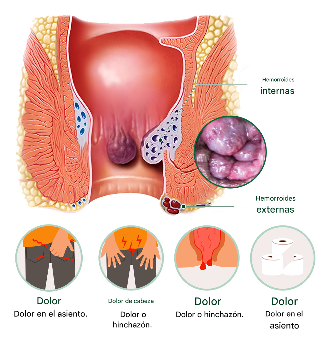 Timilk® SootheMist PRO Spray para hemorroides