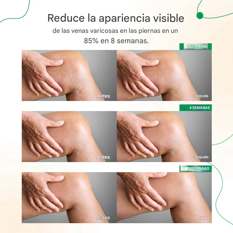 ODALIT™ - 2x1 Crema para la reducción de varices
