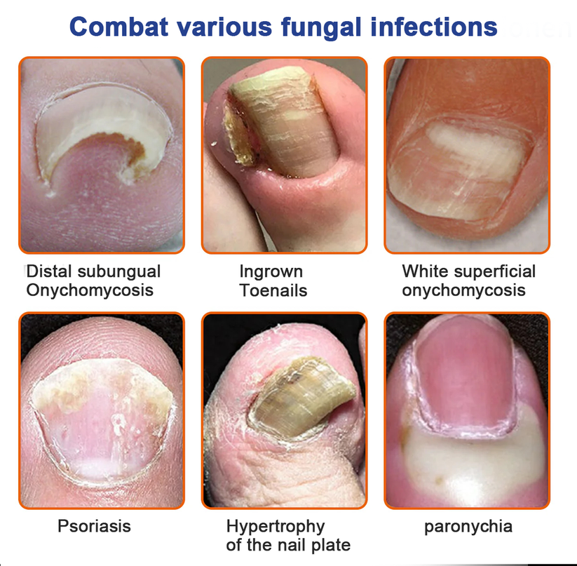 Solución para el tratamiento de hongos en las uñas con veneno de abeja