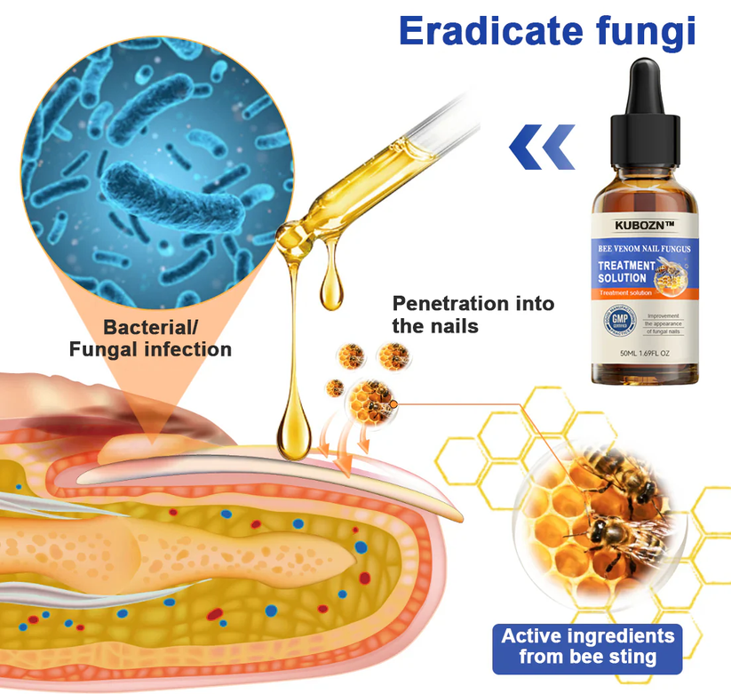 Solución para el tratamiento de hongos en las uñas con veneno de abeja