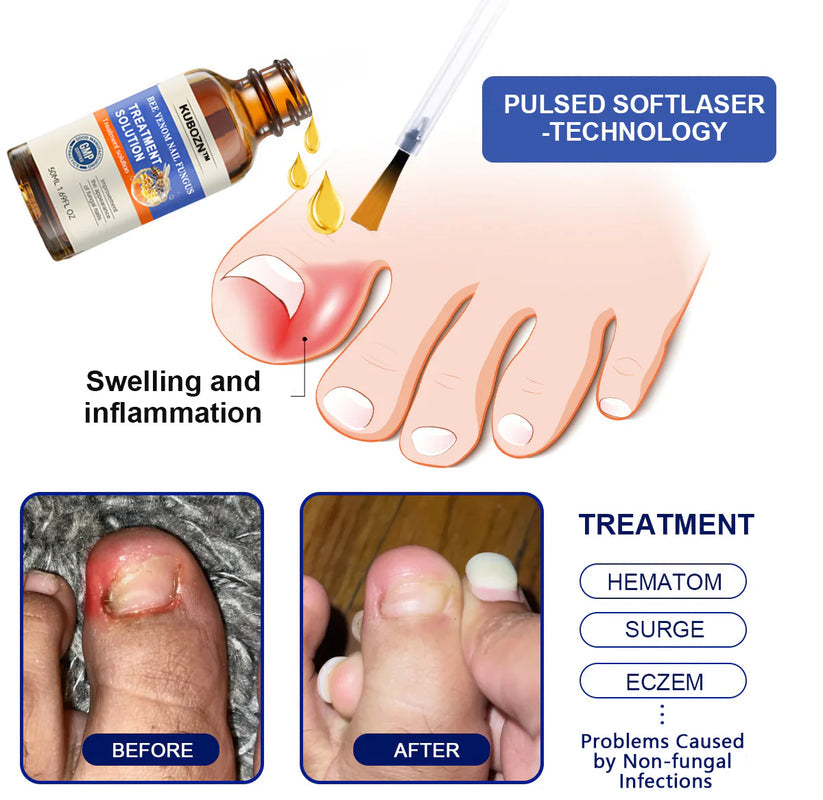 Solución para el tratamiento de hongos en las uñas con veneno de abeja