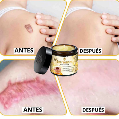 Tratamiento Crema Veneno De Abeja Para eliminar imperfecciones en la piel