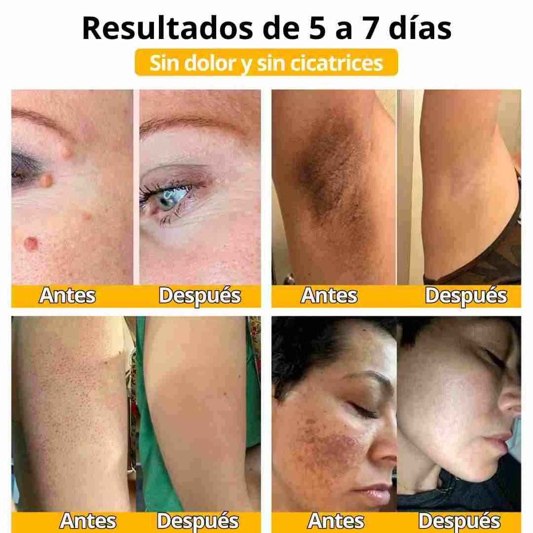 Tratamiento Crema Veneno De Abeja Para eliminar imperfecciones en la piel