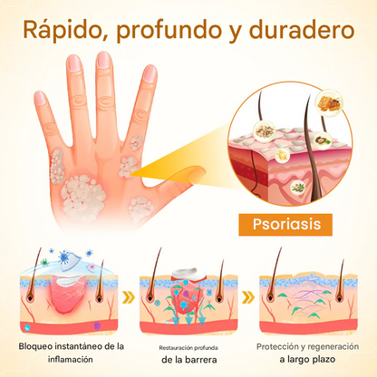 Crema para el cuidado de la piel con psoriasis ATTDX® BeeSooth