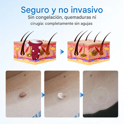 Crema para eliminar verrugas Timilk® TagGone