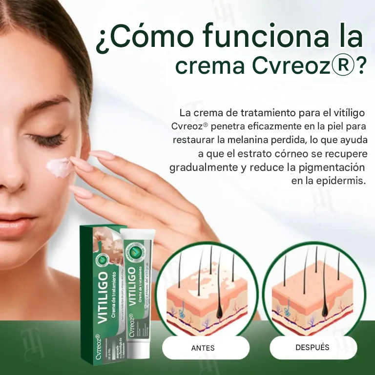 Crema para el tratamiento del vitíligo Cvreoz®