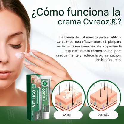 Crema para el tratamiento del vitíligo Cvreoz®