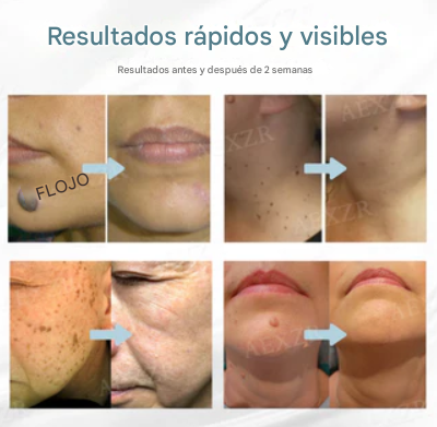 Bikenda® Láser Portátil – Elimina Verrugas,Lunares y Manchas de Forma Rápida y Sin Dolor