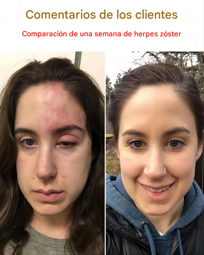🐝✨𝑩𝑺𝑾𝑬𝑳𝑳® Crema de Veneno de Abeja 👨‍⚕️ (Recomendada por dermatólogos) (70% de descuento)
