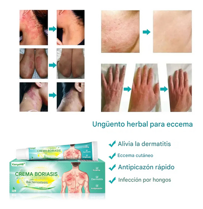 Crema Para La Psoriasis Y El Eczema, Crema Antipicazón A