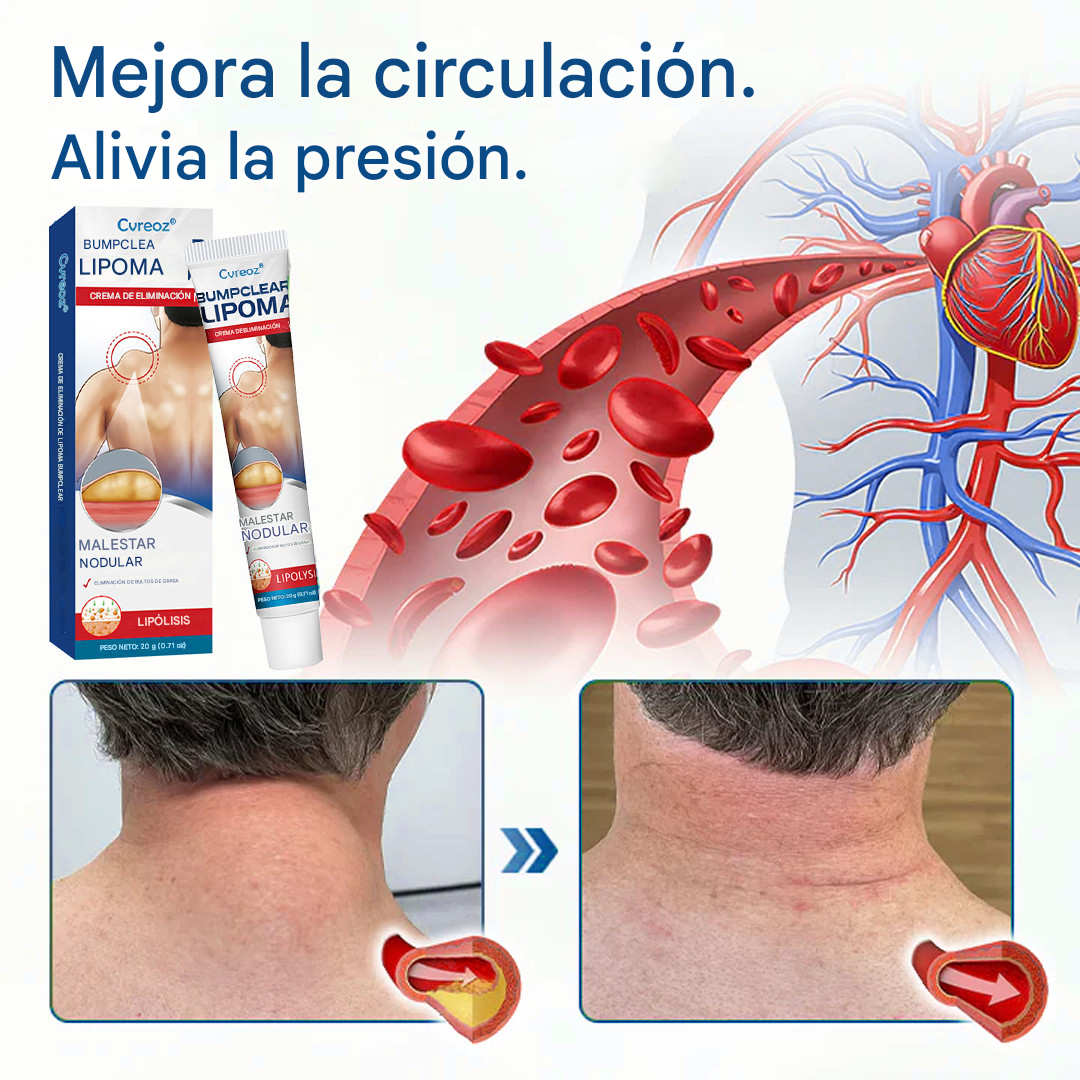 Crema para la eliminación de lipomas Cvreoz® BumpClear