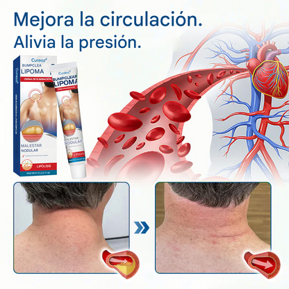 Crema para la eliminación de lipomas Cvreoz® BumpClear