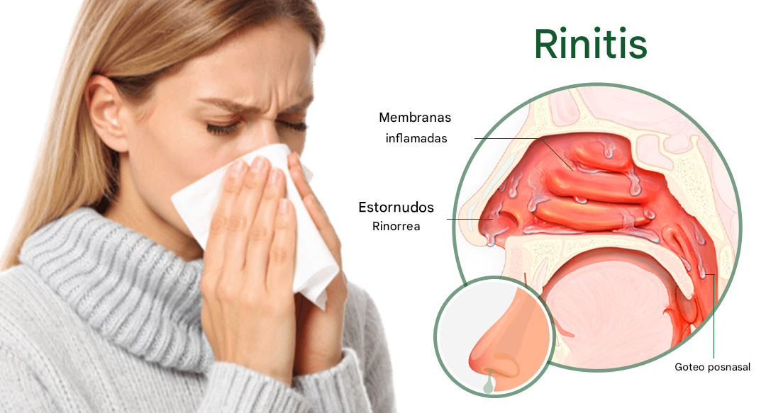 Healrize® BioActive Herbal Sinus Mist - Spray para aliviar la sinusitis y la fiebre del heno