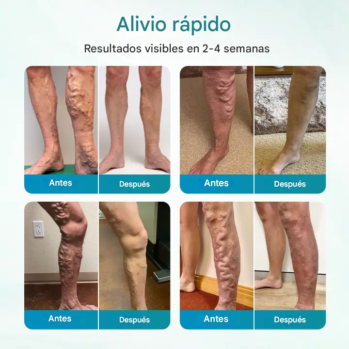 Crema para el alivio de las venas Timilk® VeinAway