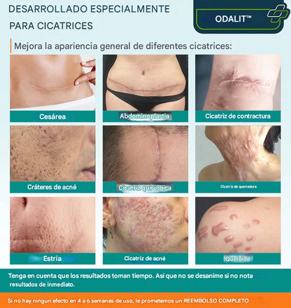 ODALIT™ Spray para cicatrices para todo tipo de cicatrices