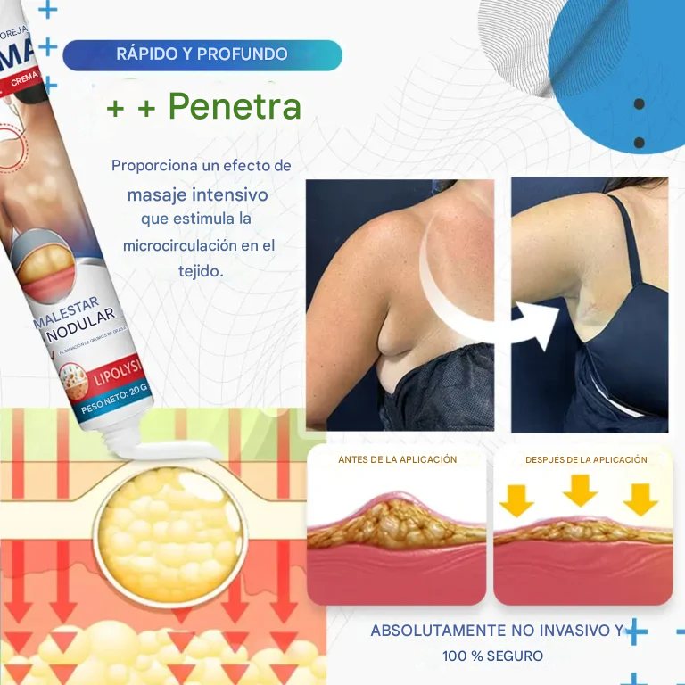 Crema para la eliminación de lipomas Cvreoz® BumpClear