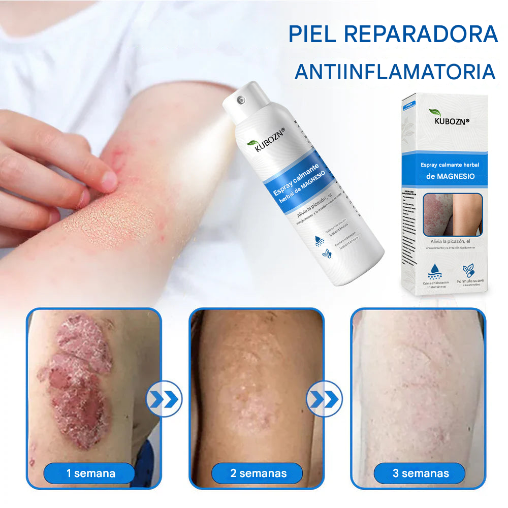 Kubozn® Magnesium Herbal Psoriasis Spray Alivia la psoriasis y el eczema