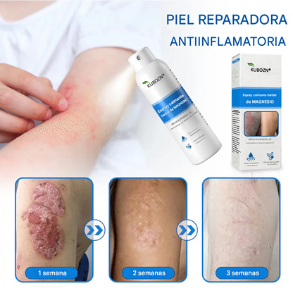 Kubozn® Magnesium Herbal Psoriasis Spray Alivia la psoriasis y el eczema
