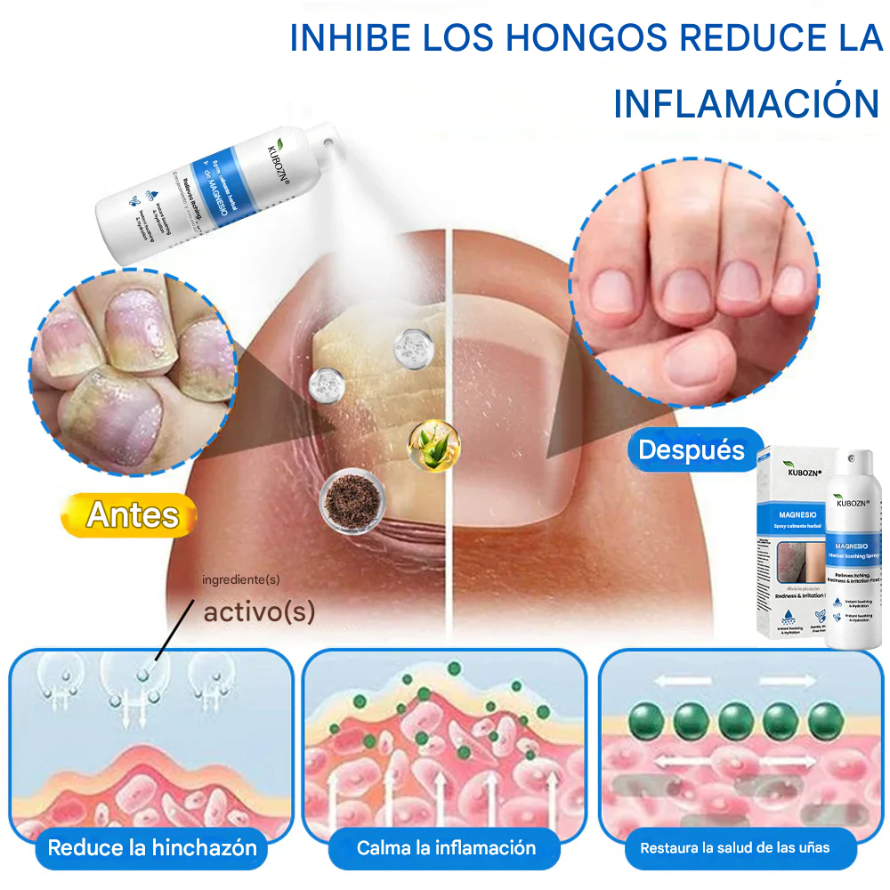 Kubozn® Magnesium Herbal Psoriasis Spray Alivia la psoriasis y el eczema