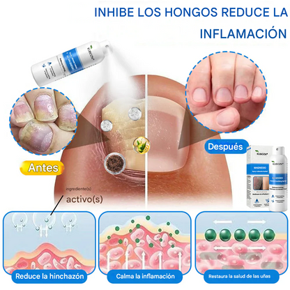Kubozn® Magnesium Herbal Psoriasis Spray Alivia la psoriasis y el eczema