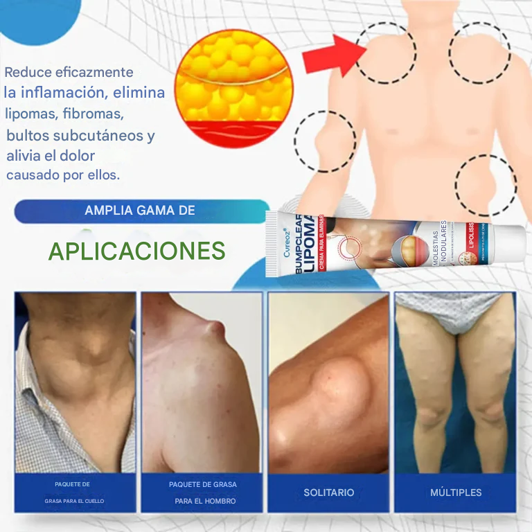 Crema para la eliminación de lipomas Cvreoz® BumpClear