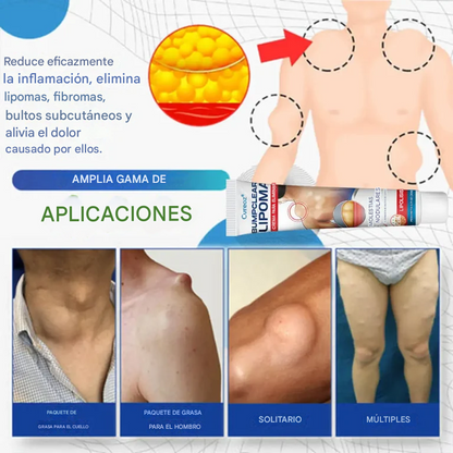 Crema para la eliminación de lipomas Cvreoz® BumpClear