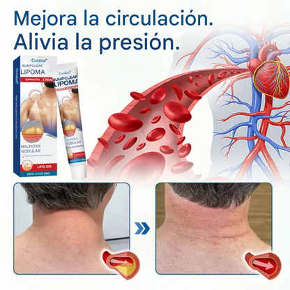 Crema para la eliminación de lipomas Cvreoz® BumpClear