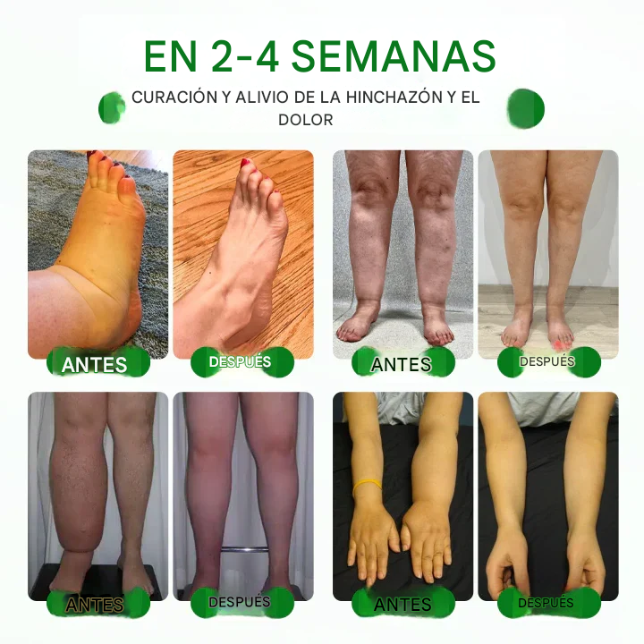 VenoLift Timilk® Spray Para Alivio pesadas e hinchases