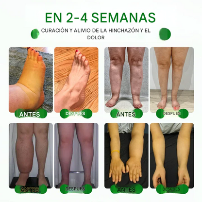 VenoLift Timilk® Spray Para Alivio pesadas e hinchases