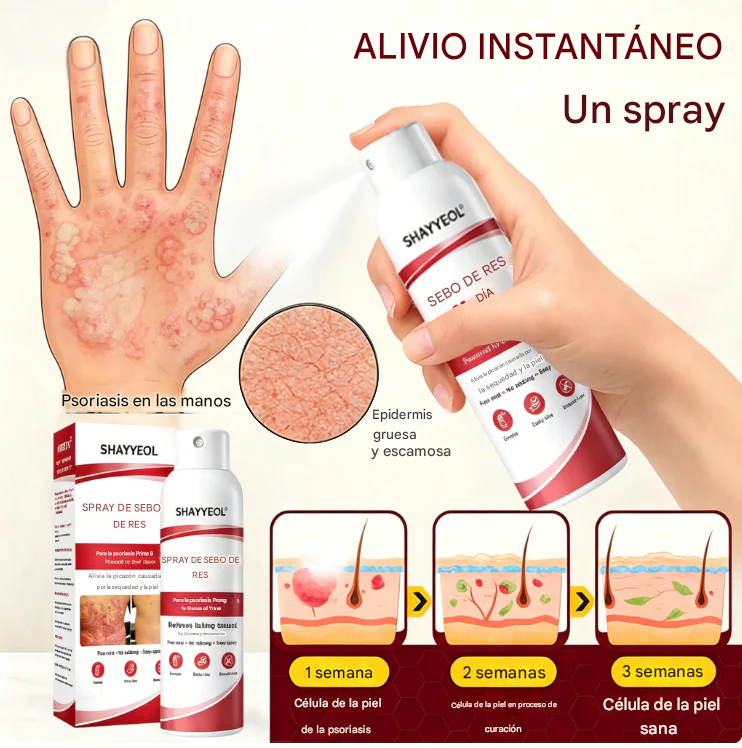 Spray de sebo de res: calma y repara la piel con psoriasis rápidamente | Sin frotar
