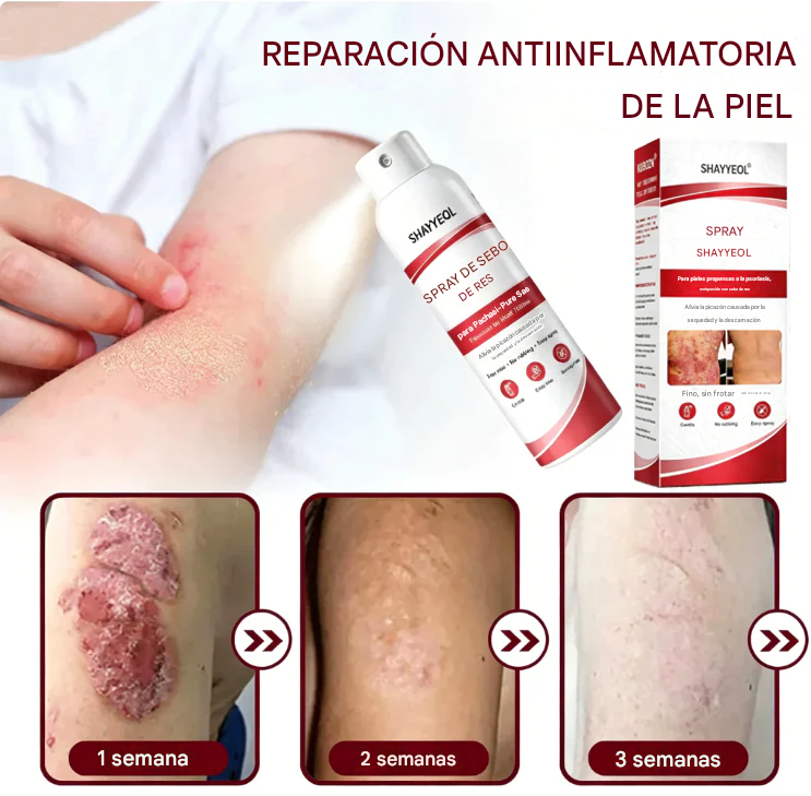 Spray de sebo de res: calma y repara la piel con psoriasis rápidamente | Sin frotar