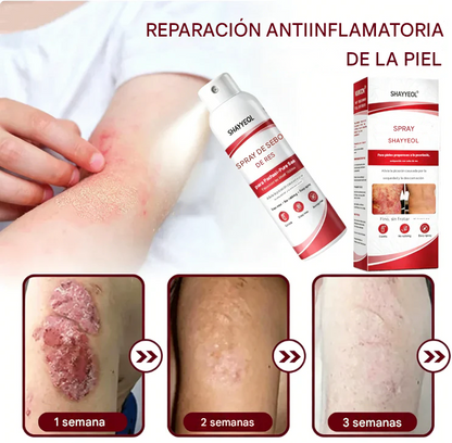 Spray de sebo de res: calma y repara la piel con psoriasis rápidamente | Sin frotar