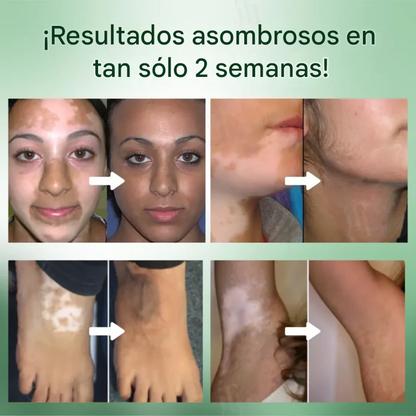 Crema para el tratamiento del vitíligo Cvreoz®